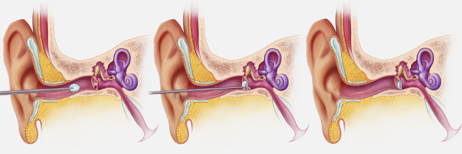 Non-invasive process of installing PhonoGraft through the ear canal