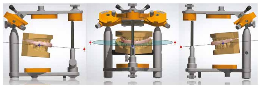 Digital model design of splint