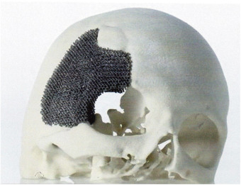 Ti-6Al-4 V rhombic dodecahedron mesh skull insert manufactured by EBM Ti-6Al-4 V rhombic dodecahedron mesh skull insert manufactured by EBM