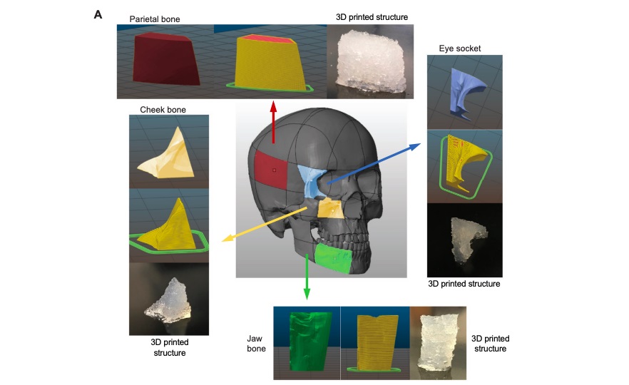 The researchers’ biomaterials can be used to make a variety of facial implants, including implants for cheek, eye socket, and jaw surgery class=