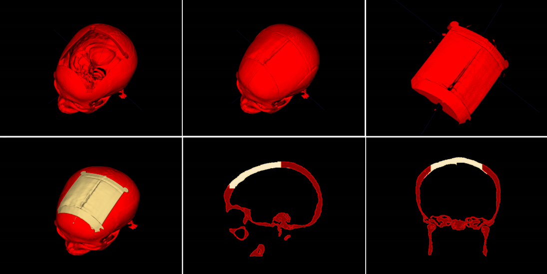 Researchers in Austria have developed an automated process that allows users to design skull implants Researchers in Austria have developed an automated process that allows users to design skull implants