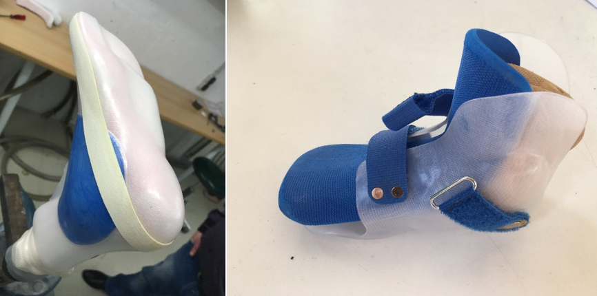 Vacuum thermoforming of a new type of orthosis shell Vacuum thermoforming of a new type of orthosis shell