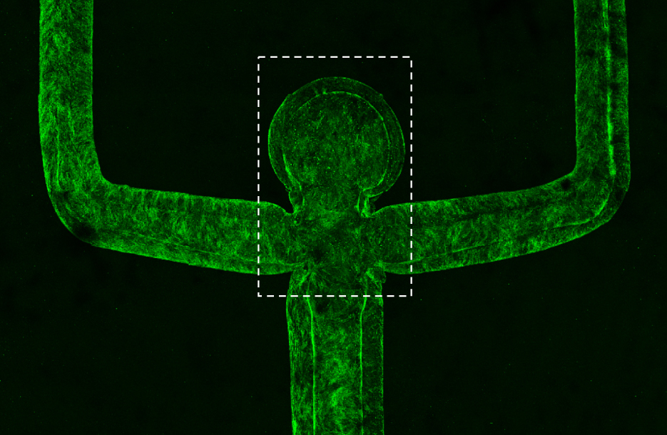 The researchers’ aneurysm  The researchers’ aneurysm