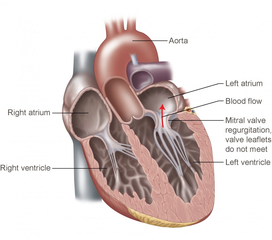 Mitral valve regurgitation diagram