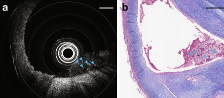 Images captured using the research team's endoscopic device show necrotic cores of dead cells Images captured using the research team's endoscopic device show necrotic cores of dead cells